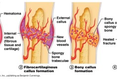 Speed Healing of Bone Fracture