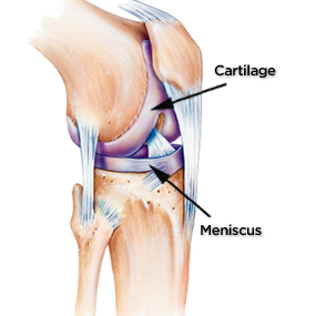 285x285_Severe_Knee_Pain_Slide_3