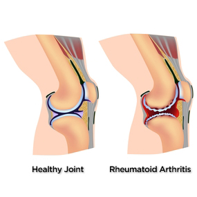 285x285_Severe_Knee_Pain_Slide_5