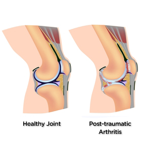 285x285_Severe_Knee_Pain_Slide_6