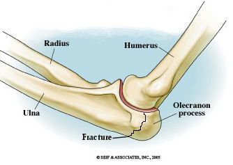 Elbow Injuries and Fractures