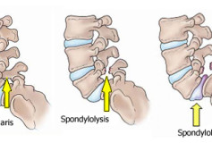 What is Spondylosis