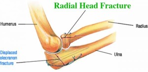 Radial-Head-Fracture