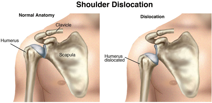 What is Shoulder Dislocation and Instability ?