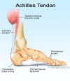 Achilles tendon rupture symptoms and treatments