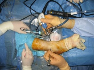 Figure 1: Anterior ankle arthroscopy set-up