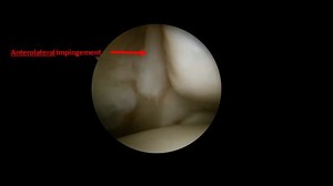 Figure 3. Arthroscopic view of the ankle showing anterolateral impingement