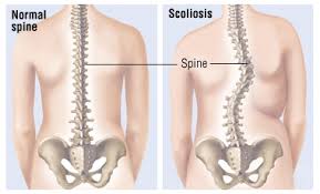 Scoliosis: What You Need to Know about Scoliosis