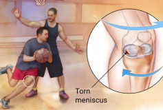 Meniscus Tear Symptoms, Causes & Treatments