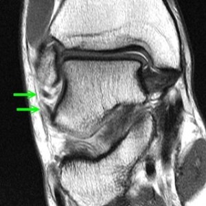 sprained ankle MRI