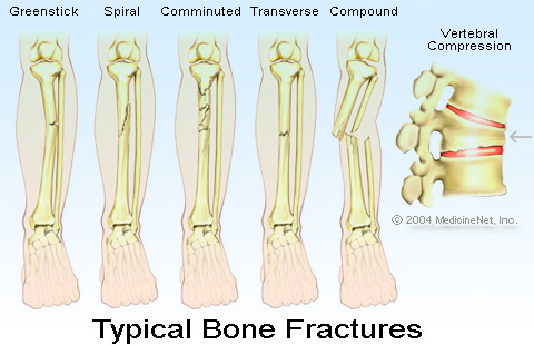 Fractures (Broken Bones)